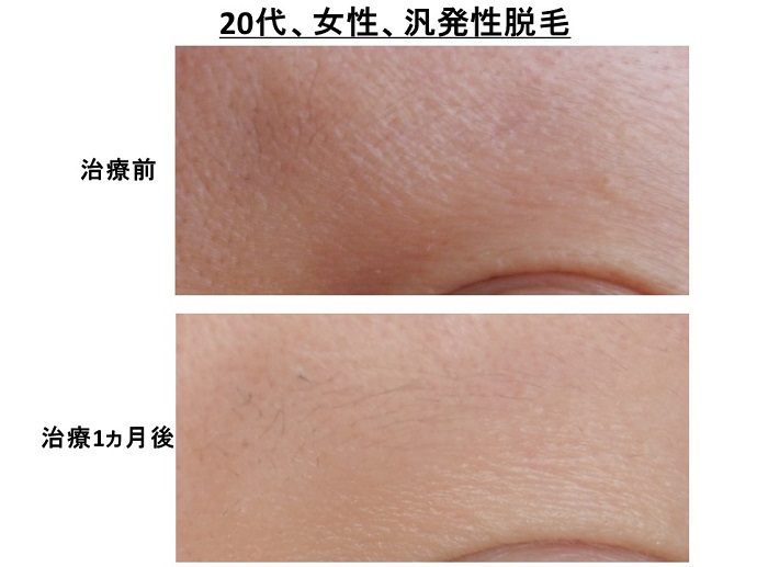 円形脱毛症　病院